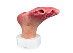 Sockelmodell Diabetisches Fußsyndr...